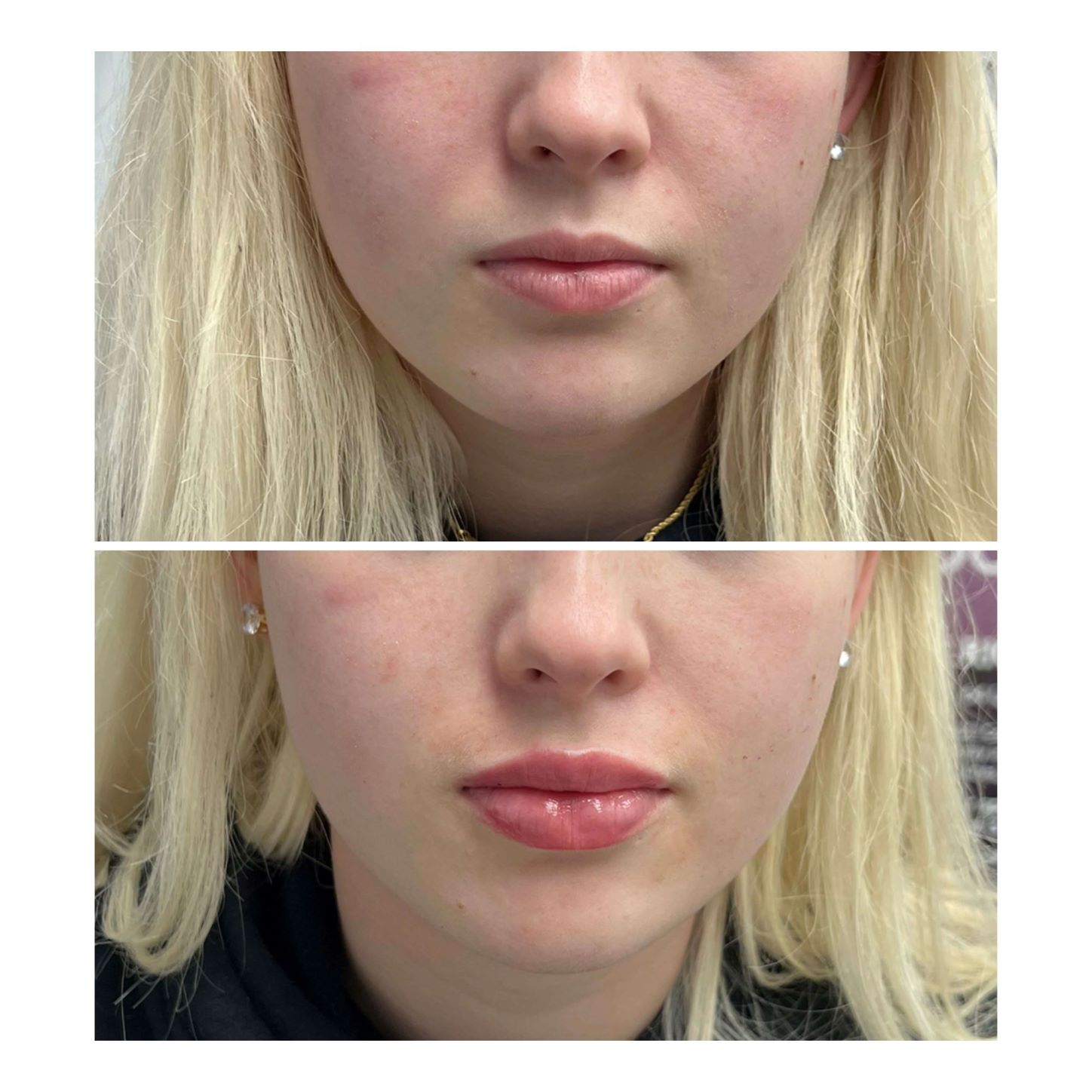 Dermal Filler to Plump Lips