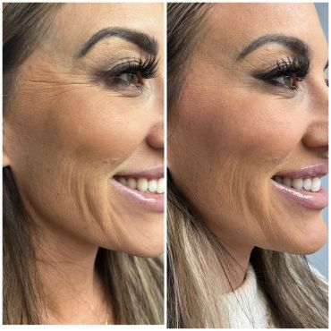 Botox for Vertical Lip Lines
