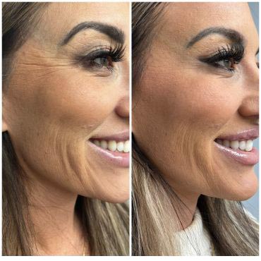 Botox for Vertical Lip Lines