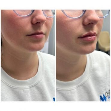 Dermal Filler to Plump Lips