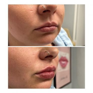 Dermal Filler to Plump Lips