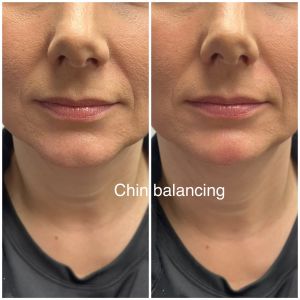 Before/After Chin